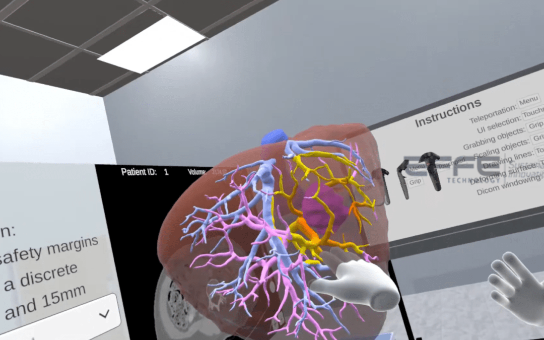 Surgery in 3D: VR Organ Simulation for Enhanced Preoperative Insight